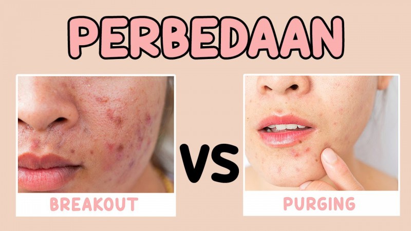 Cara Membedakan Purging dan Breakout