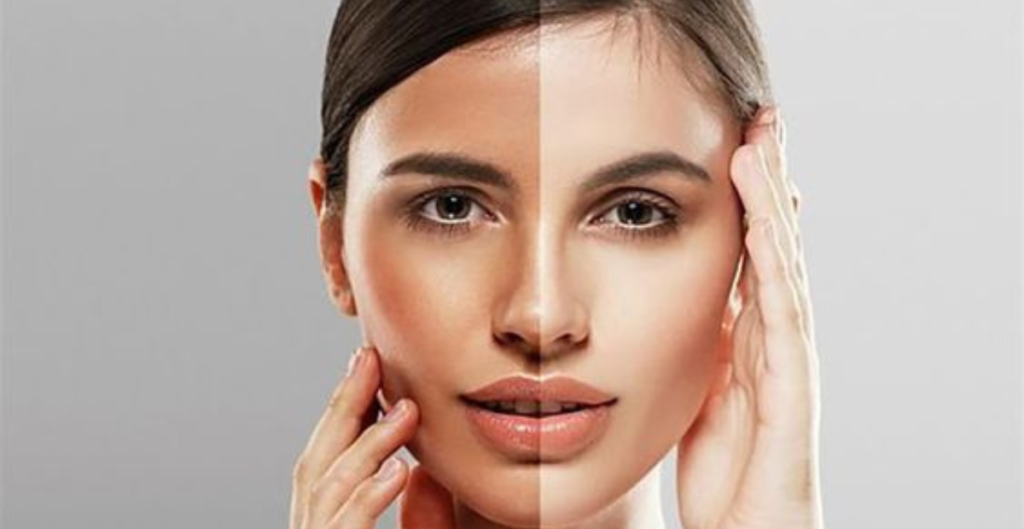 penyebab kulit belang